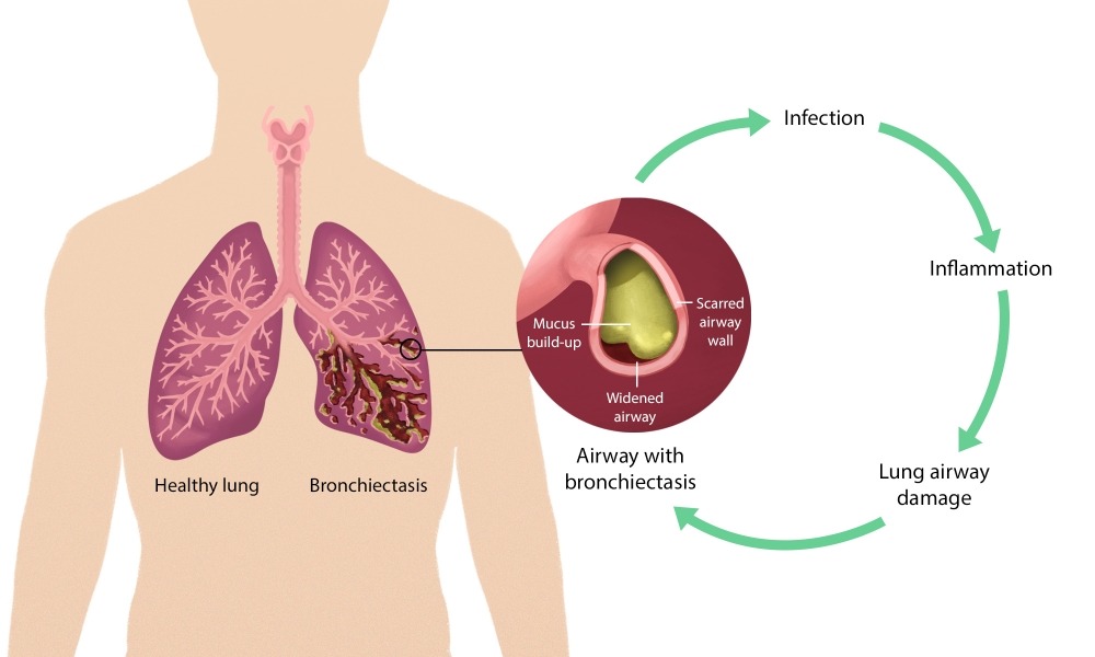 What is Bronchiectasis, its causes, symptoms and treatment?